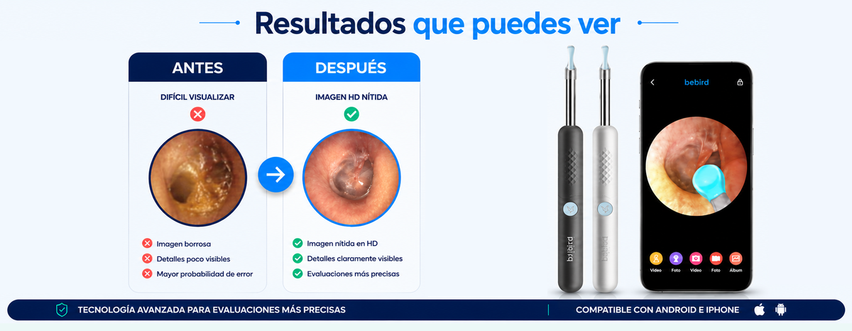 Otoscopio Digital BeBird R1